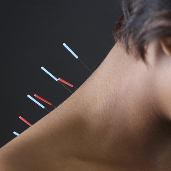 Seirin J-Type no 8 Dry Needling 0,30 x 50 mm